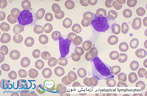 atypical lymphocytes در آزمایش خون چیست ؟